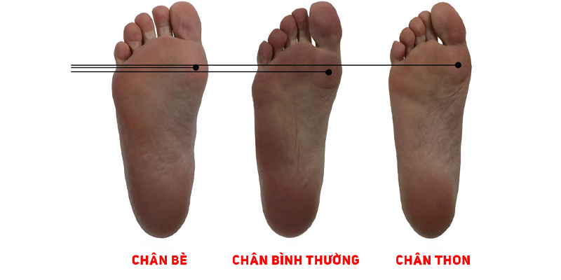 Giới thiệu: Vì sao người chân bè cần giày phù hợp?