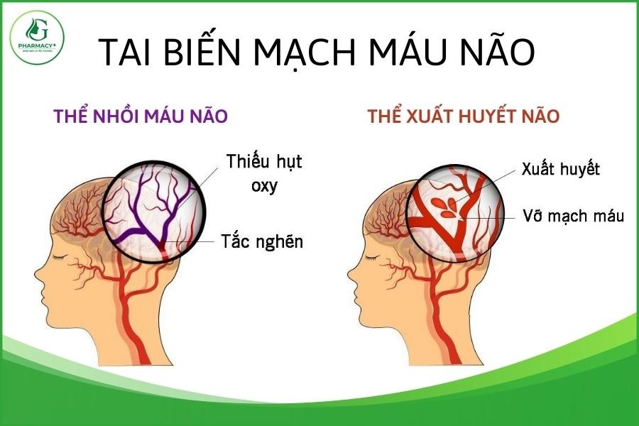 Một số điều cần biết về bệnh tai biến