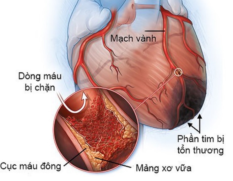 Bệnh tim