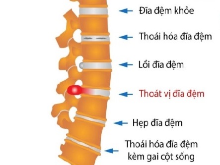 Bệnh thoát vị đĩa đệm