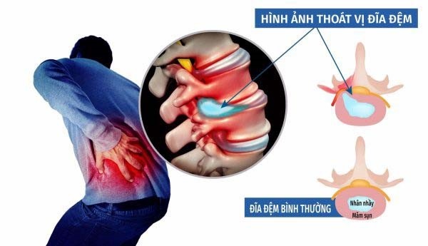 Thoát vị đĩa đệm