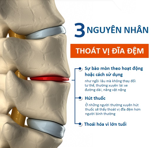 Nguyên nhân thoát vị đĩa đệm