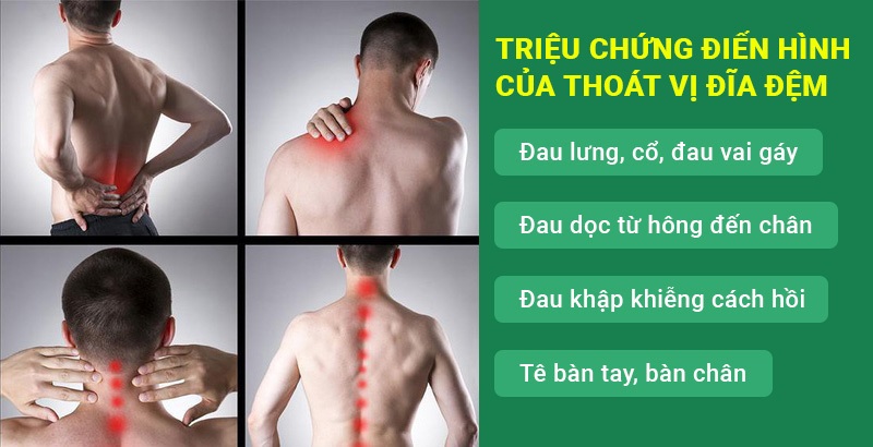 Triệu chứng thoát vị đĩa đệm